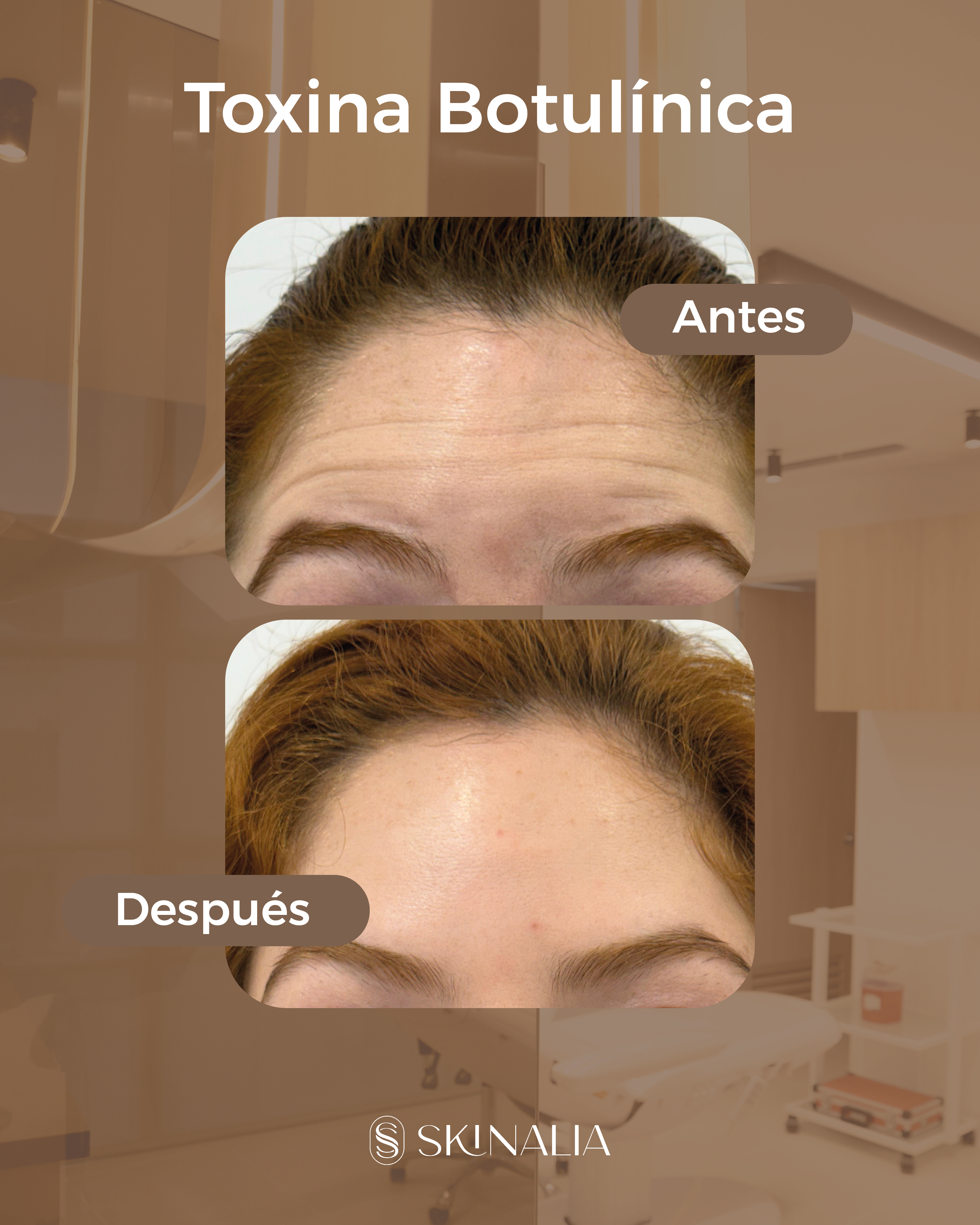 Antes y después toxina botulínica caso 1