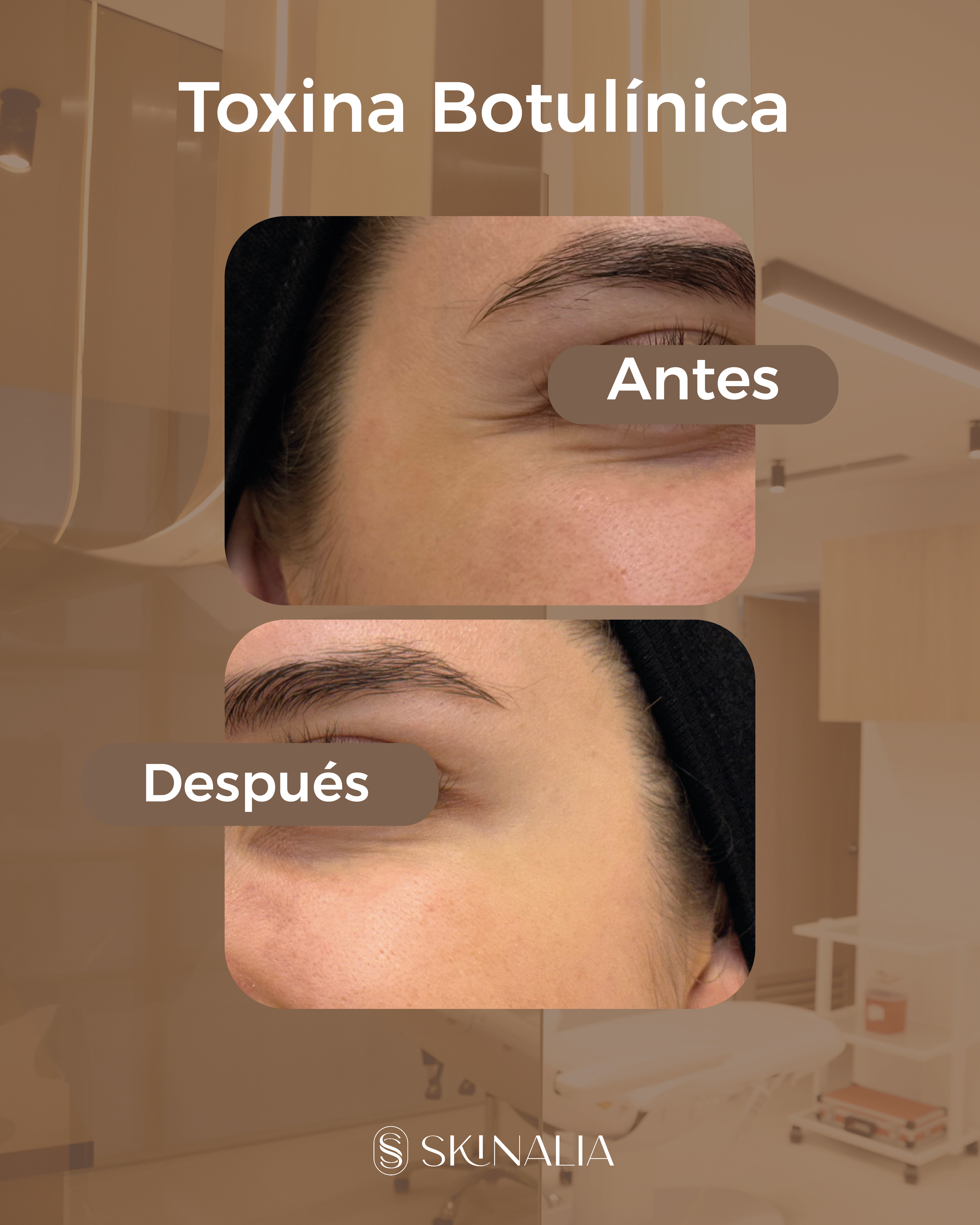 Antes y después toxina botulínica caso 10