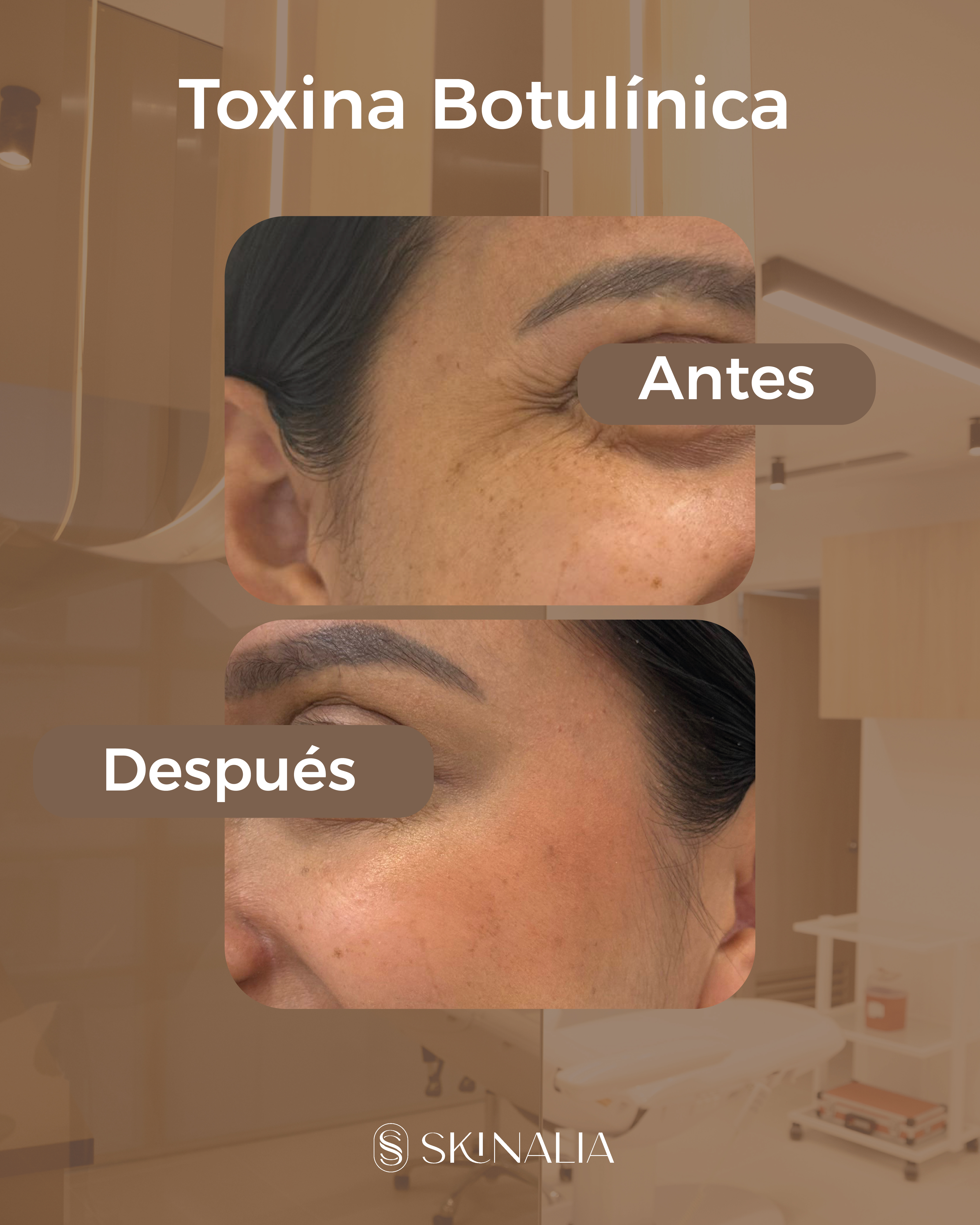 Antes y después toxina botulínica caso 11