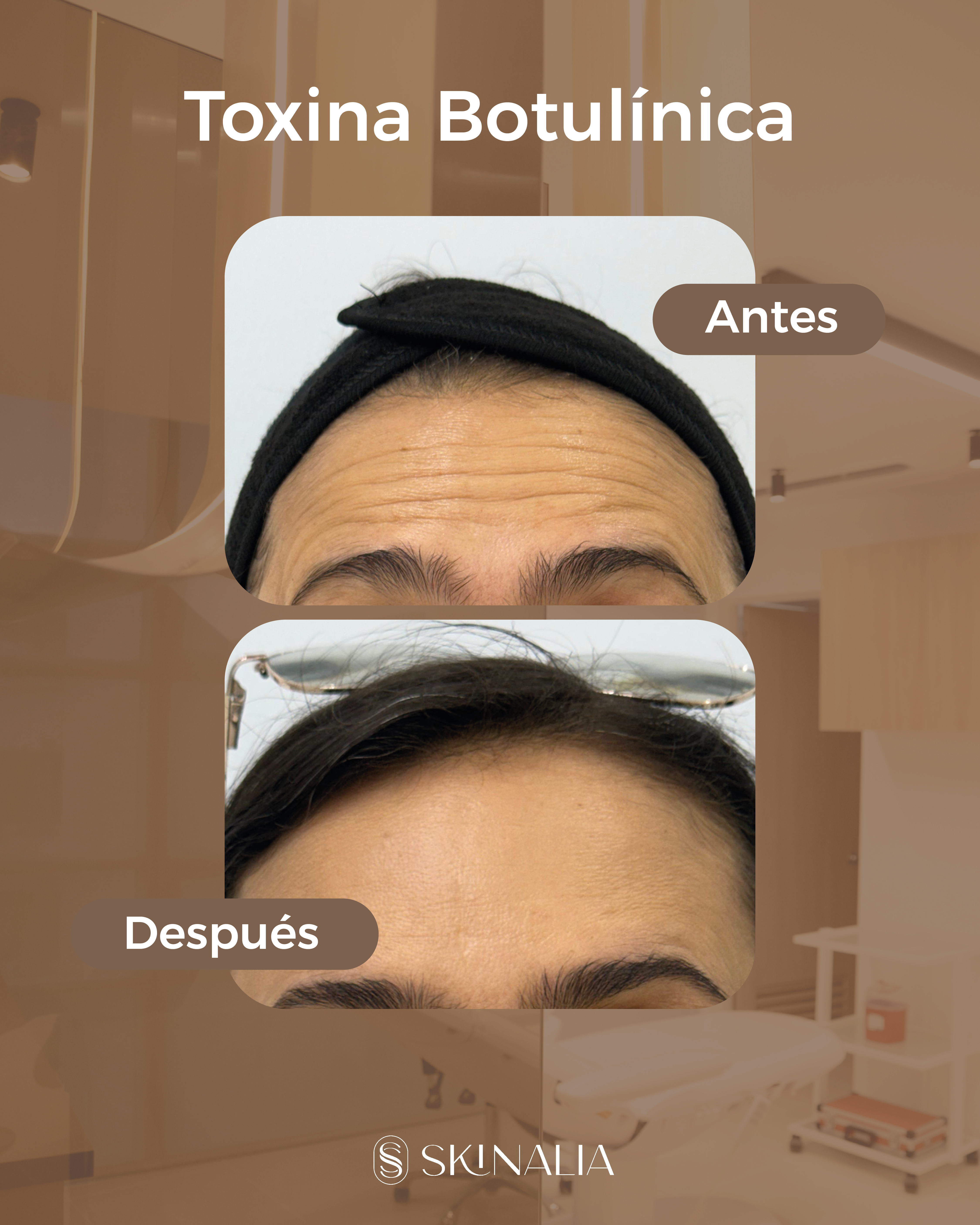 Antes y después toxina botulínica caso 3