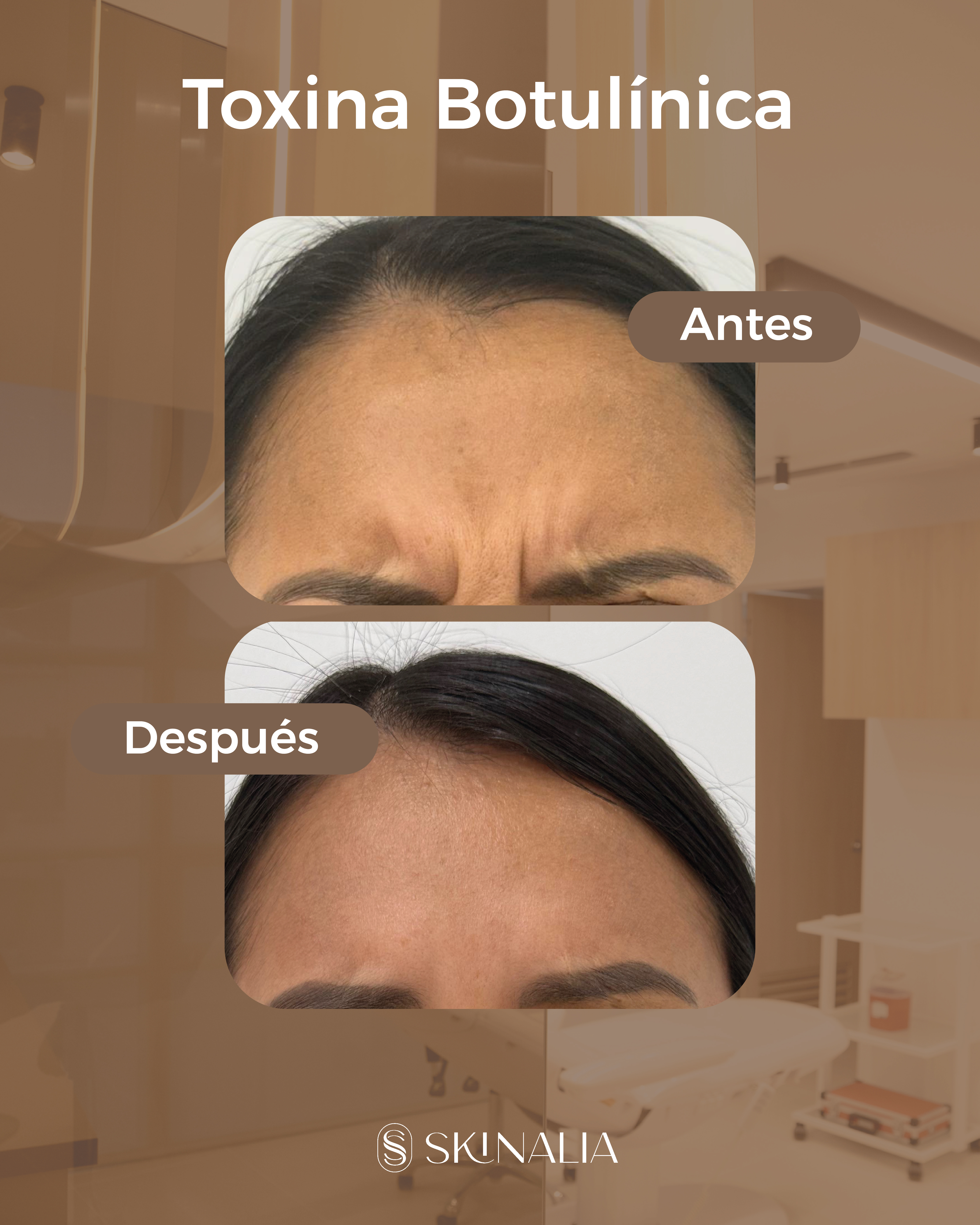 Antes y después toxina botulínica caso 4