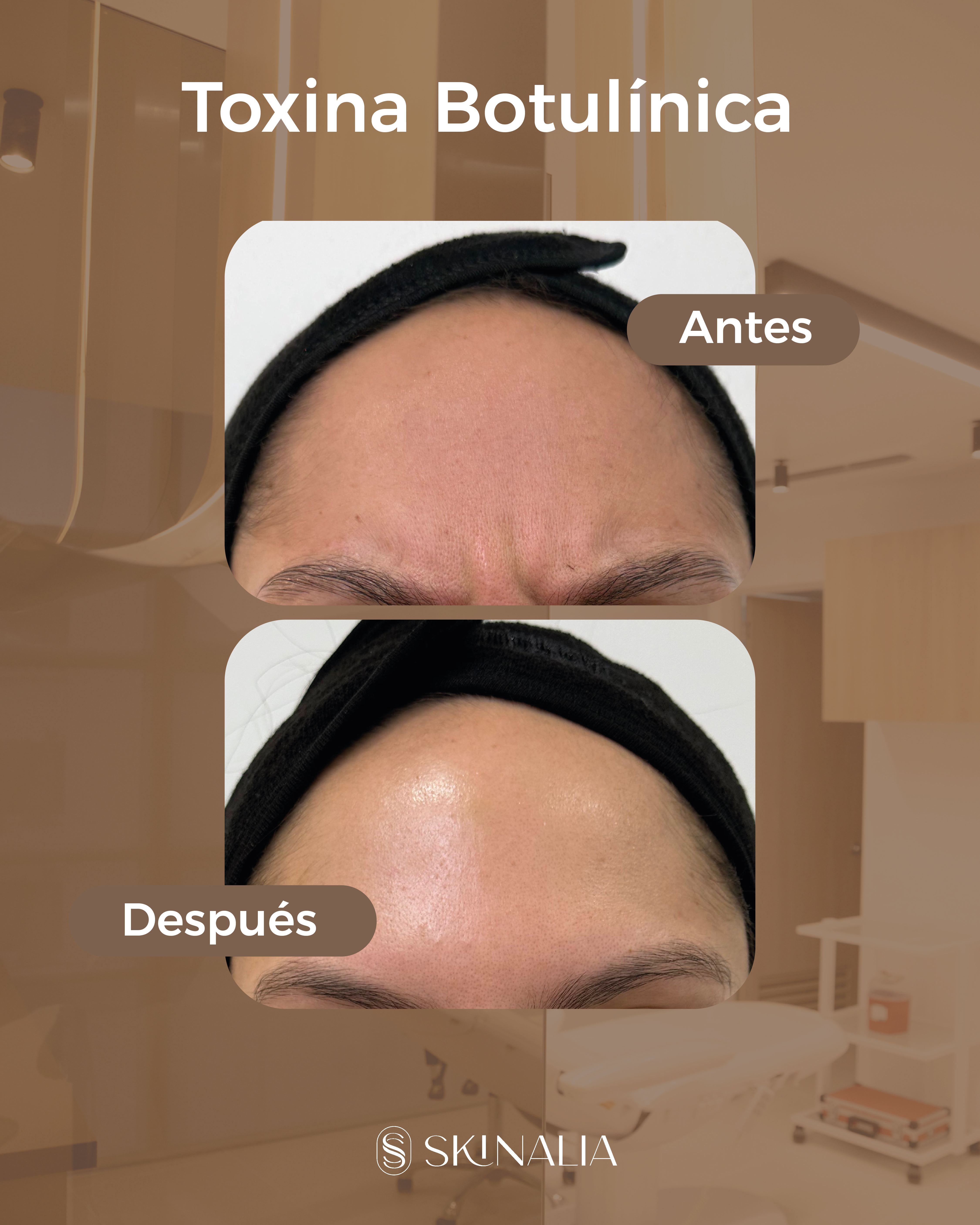 Antes y después toxina botulínica caso 5