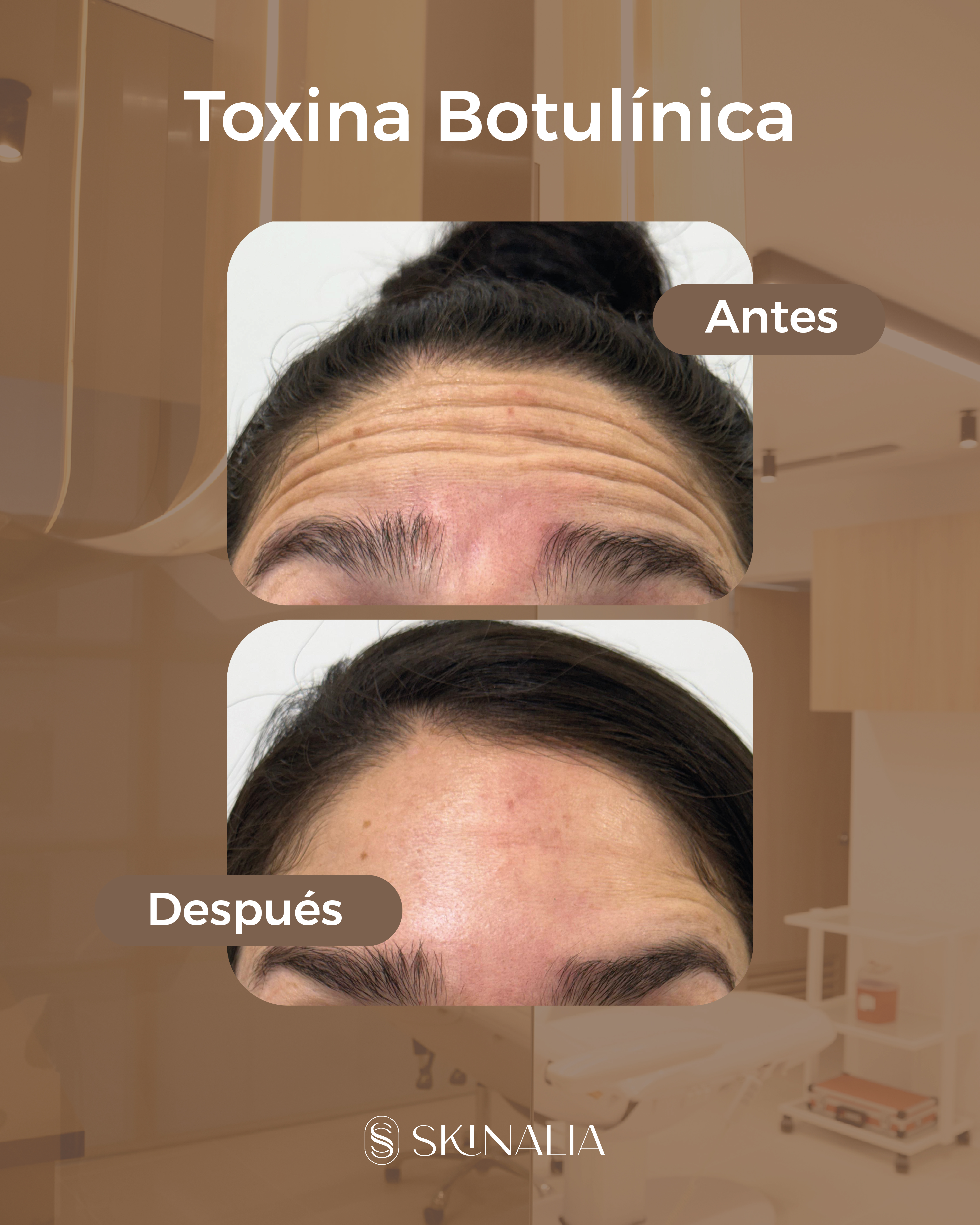 Antes y después toxina botulínica caso 6