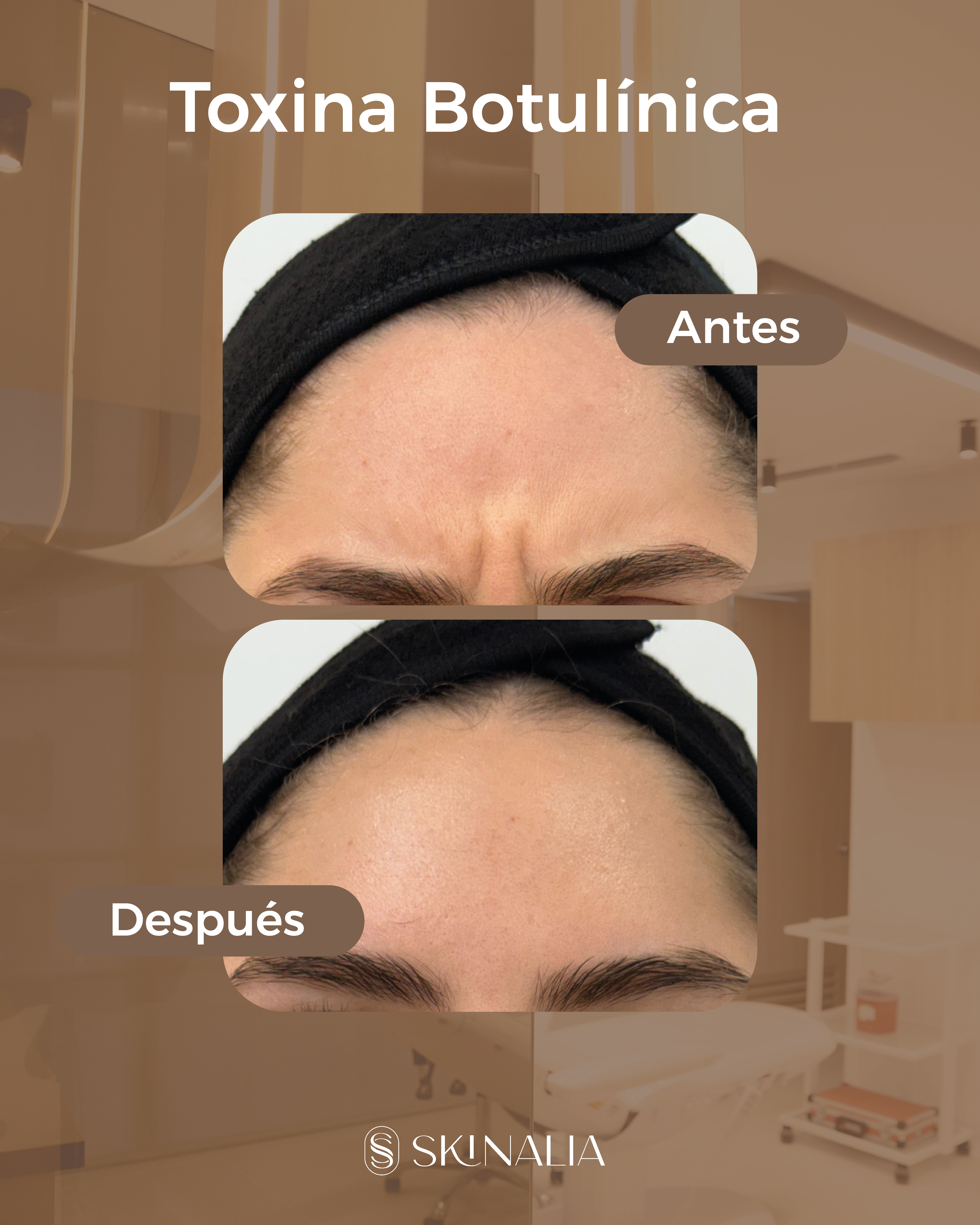 Antes y después toxina botulínica caso 7