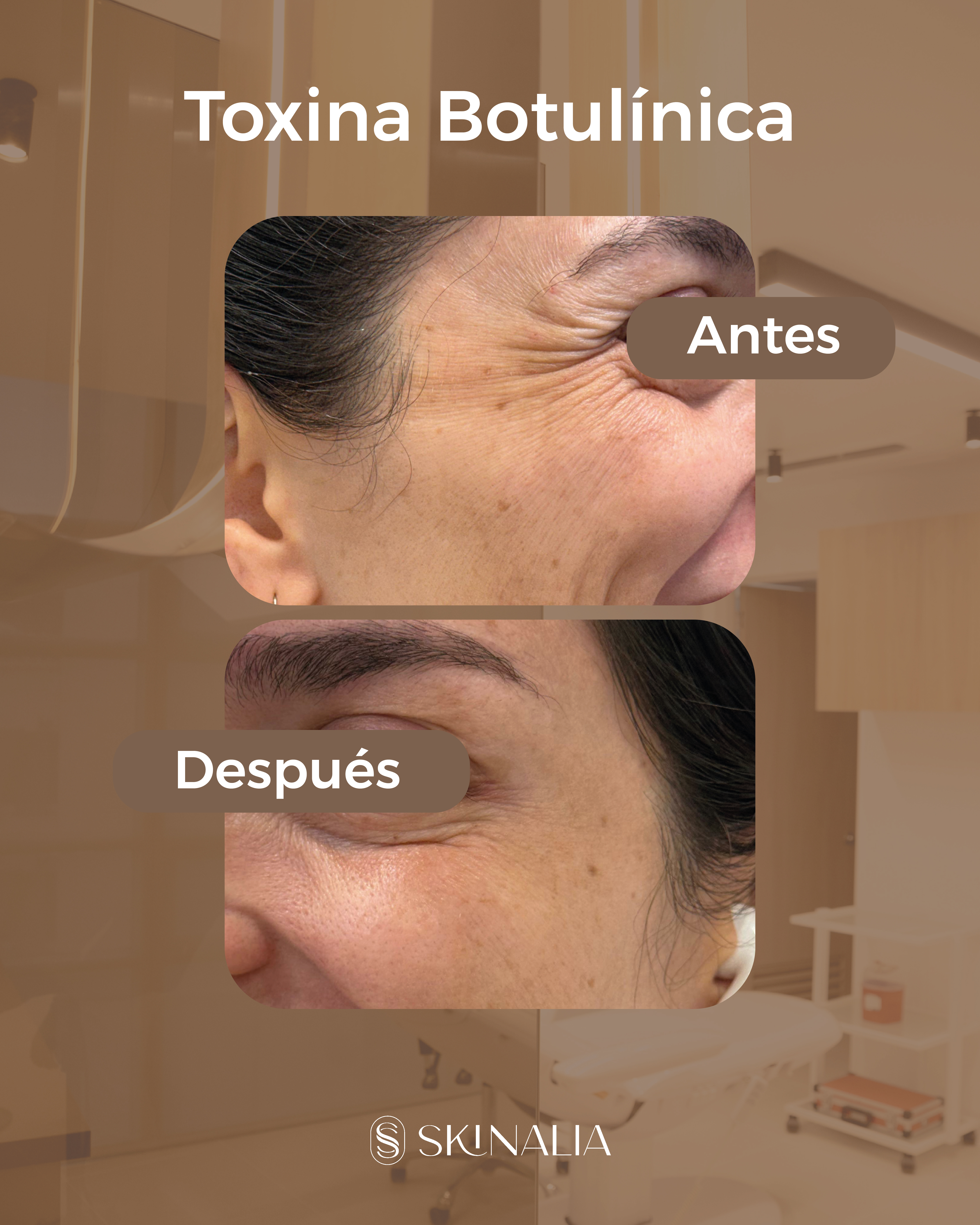 Antes y después toxina botulínica caso 8