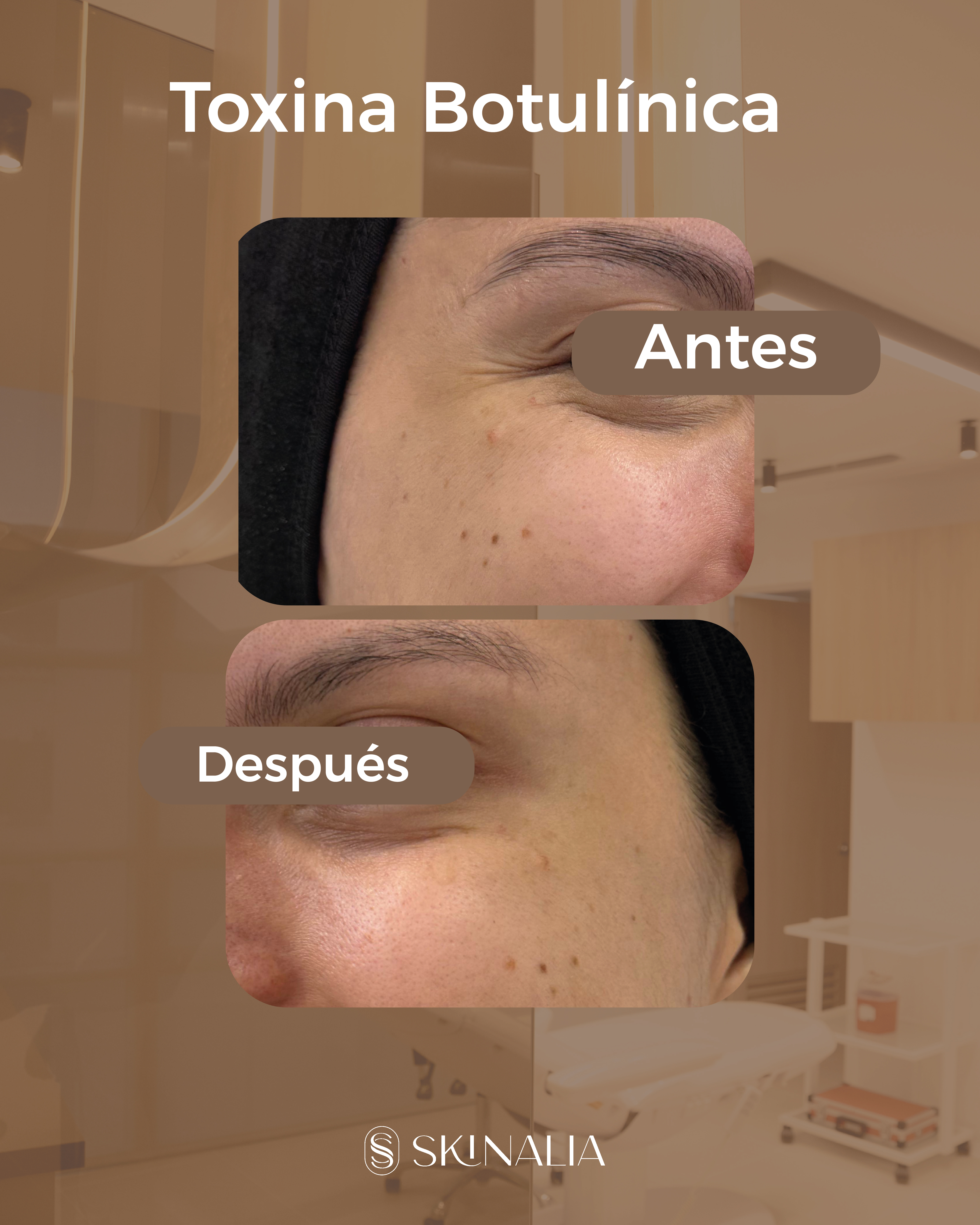Antes y después toxina botulínica caso 9