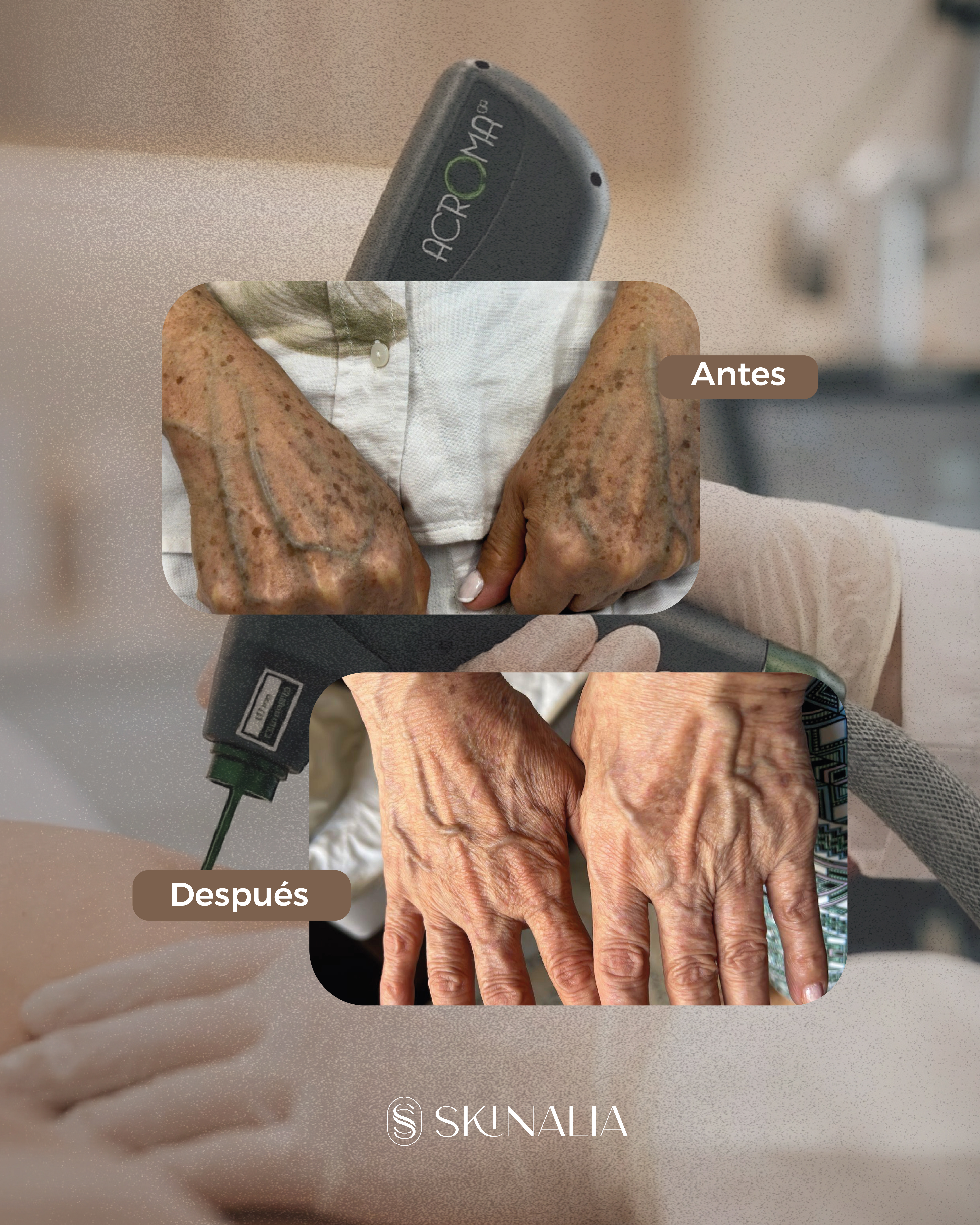 Antes y después de tratamiento de manchas en Skinalia